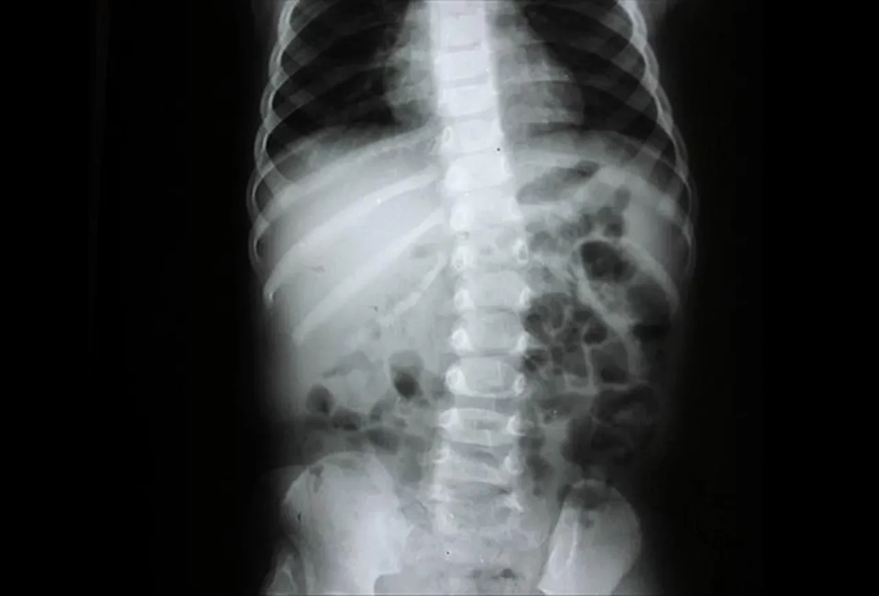 KRONİK DURUŞ BOZUKLUĞU VE OMURGA SAĞLIĞI