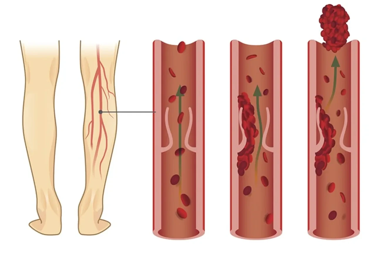 Bunları yapanlarda kalp krizi ve felç riski azalıyor! İşte kan pıhtılaşmasını engellemenin yolları
