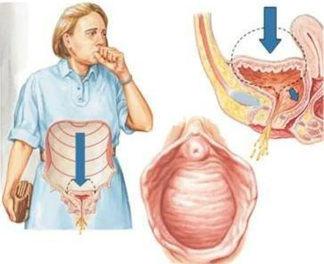 İdrar kaçırma sorunu olanlar dikkat! Rahatsızlığınızın sebebi bunlar olabilir