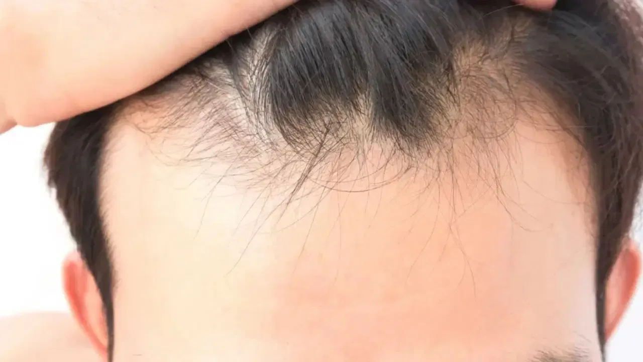 Saçlarınız bu yüzden dökülüyor olabilir! İşte onarımı için dikkat etmeniz gerekenler