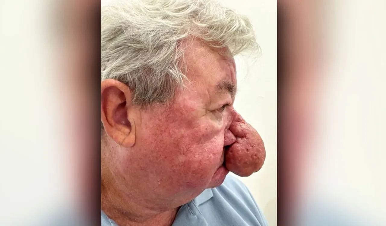 Burnu büyüdükçe büyüdü, hayatı mahvoldu, yemek bile yiyemiyordu