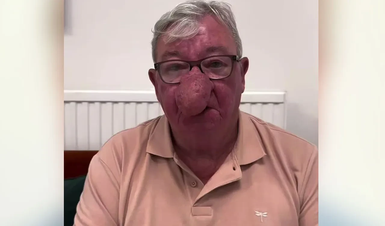 Burnu büyüdükçe büyüdü, hayatı mahvoldu, yemek bile yiyemiyordu