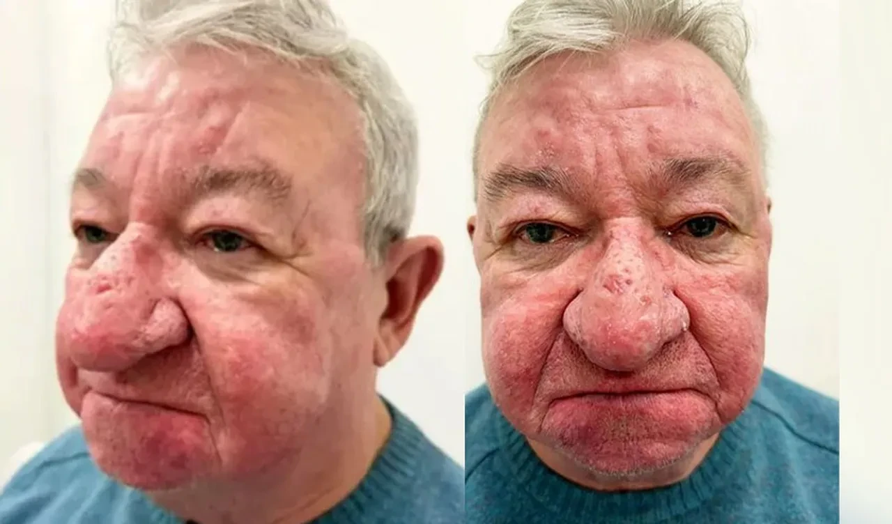 Burnu büyüdükçe büyüdü, hayatı mahvoldu, yemek bile yiyemiyordu