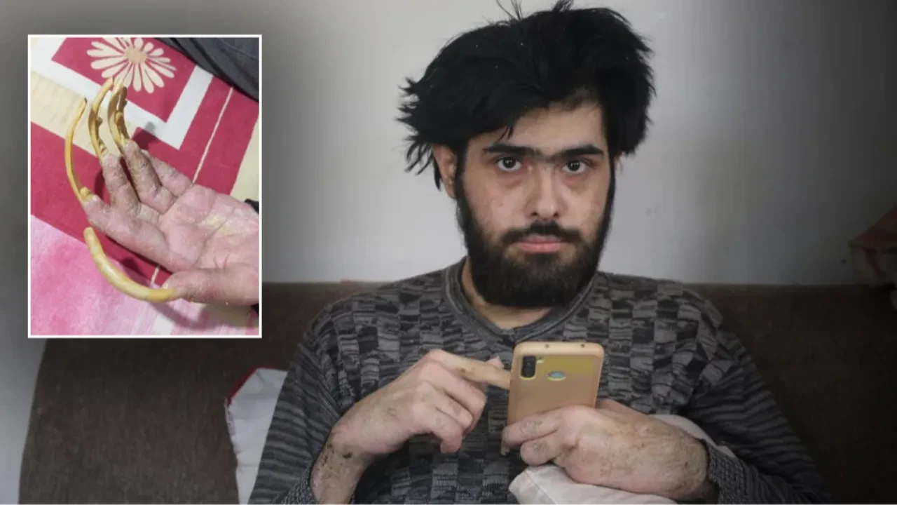 Yıllardır duş almayan, tırnaklarını kesmeyen gencin eski hali ortaya çıktı! 