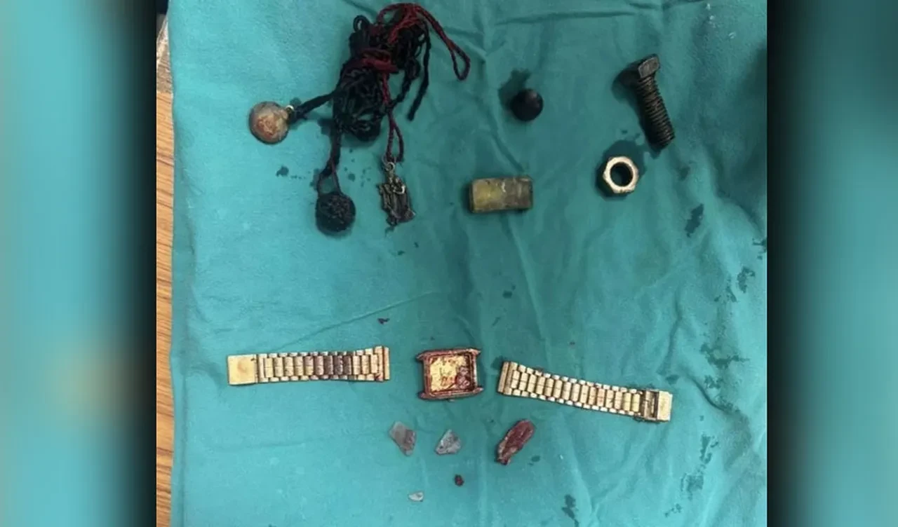 Karın ağrısıyla gittiği hastanede herkesi şoke etti: Midesi nalbur gibi