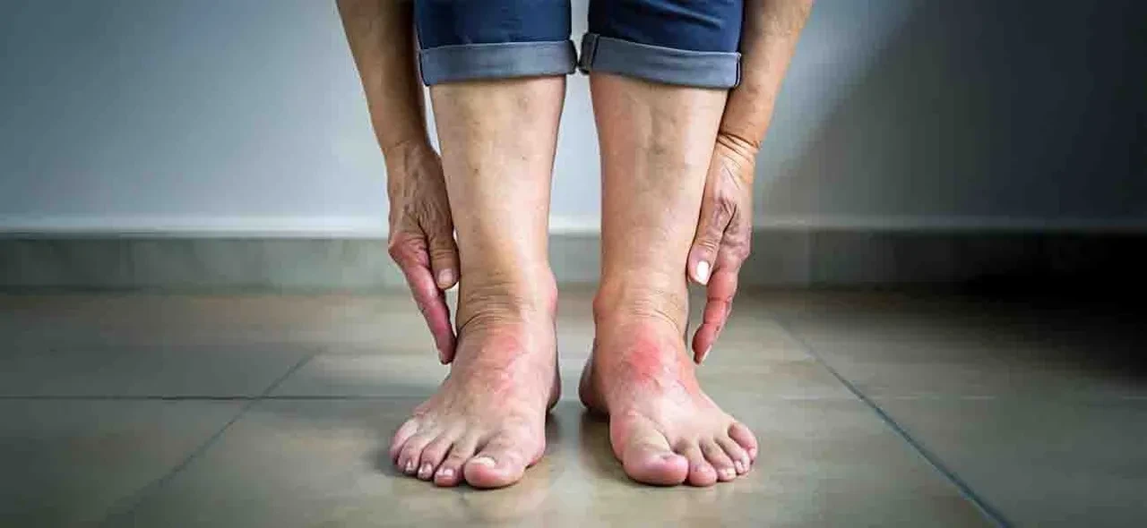 Ödemle baş etmenin etkili yolları! Şişkinliğiniz bu yüzden olabilir