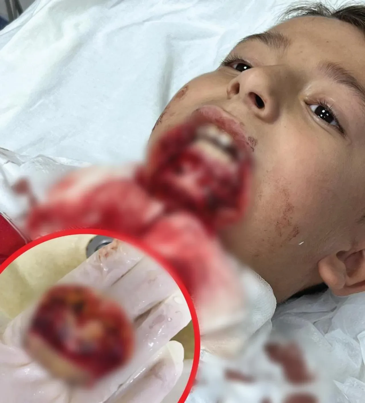 Oyun oynarken çenesi koptu! Ailesi çocuklarını görünce dehşete düştü: Okul yönetiminden skandal savunma