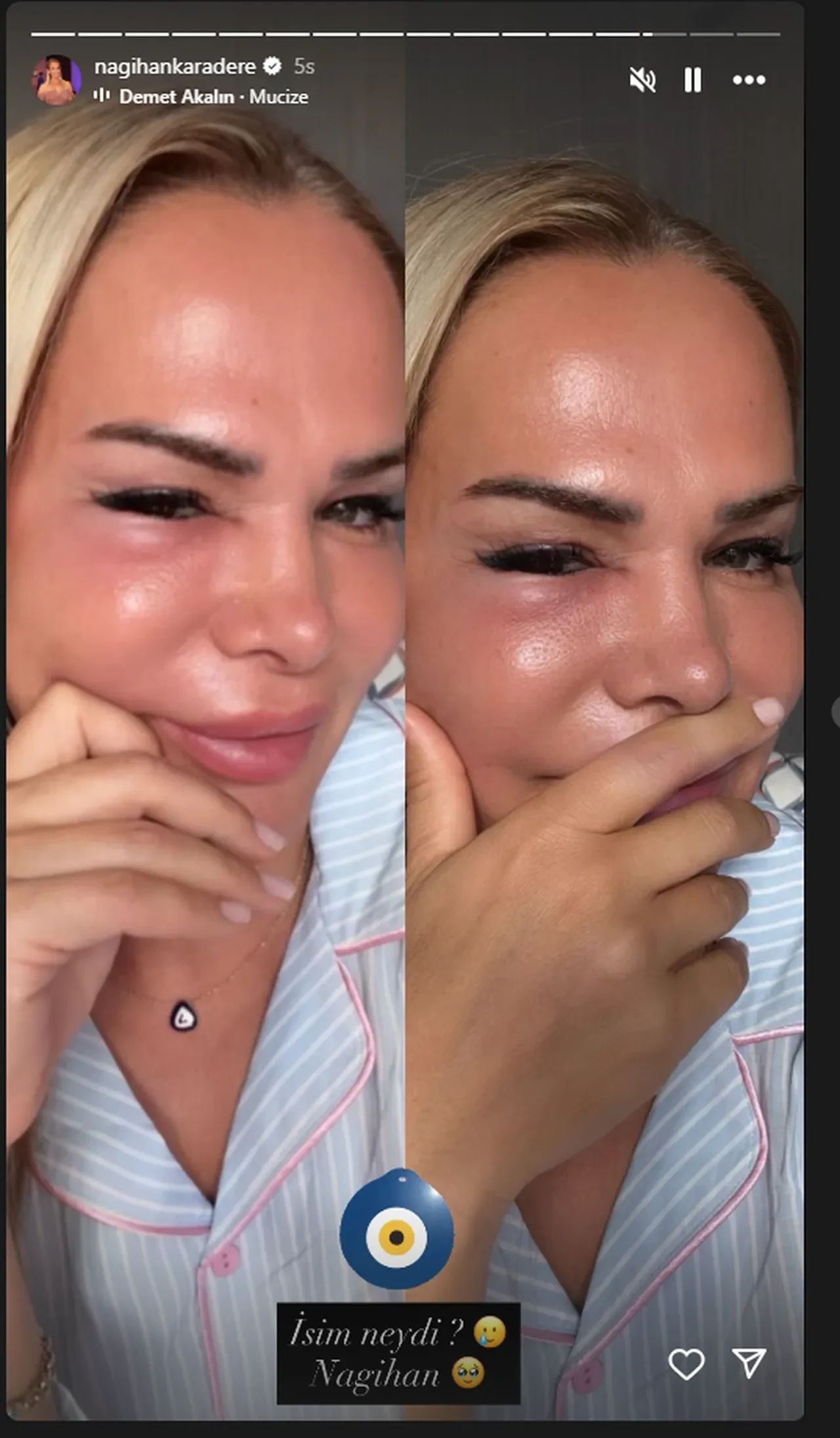 Nagihan Karadere son haliyle korkuttu! "Nazar değdi" dedi, yüzüne olanları bir bir anlattı
