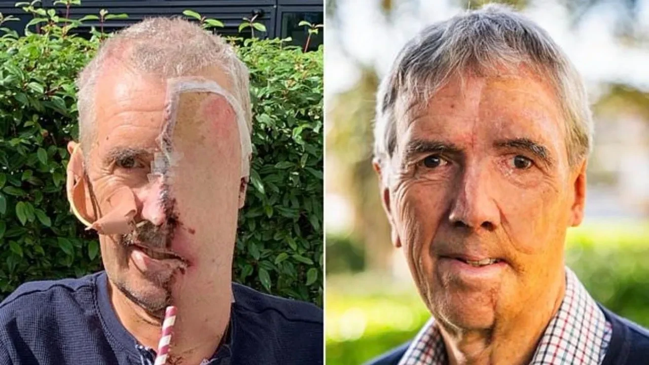 Yüzünün yarısını kazada kaybeden adamın imdadına 3D yazıcı yetişti