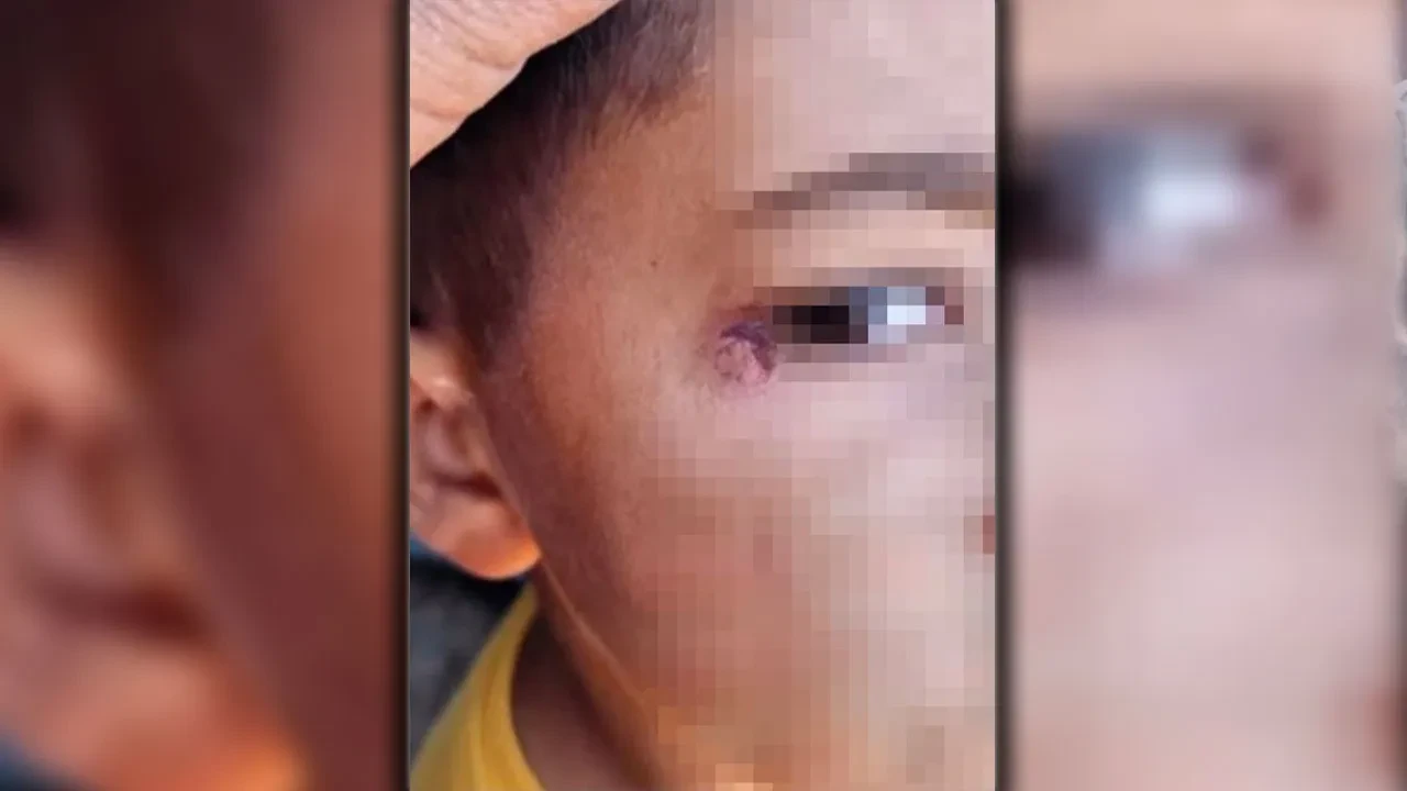 Okulda dehşete düşüren olay! İlkokul öğrencisinin yüzünde sigara söndürdü