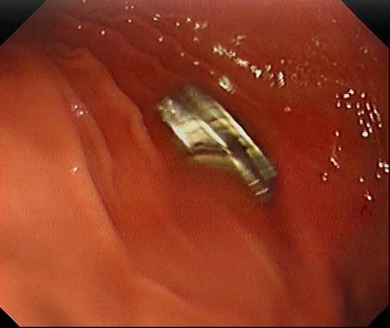 Çocuğun boğazından çıkanlar şoke etti! Tam 19 adet: Doktorlar inanamadı