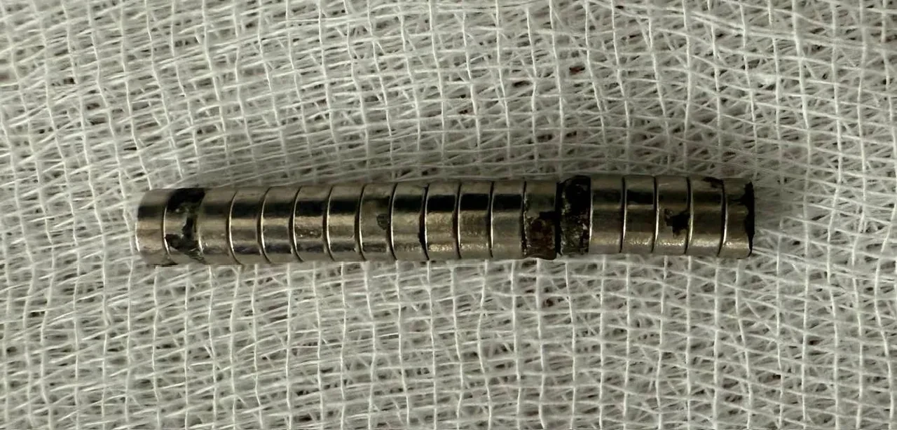 Çocuğun boğazından çıkanlar şoke etti! Tam 19 adet: Doktorlar inanamadı