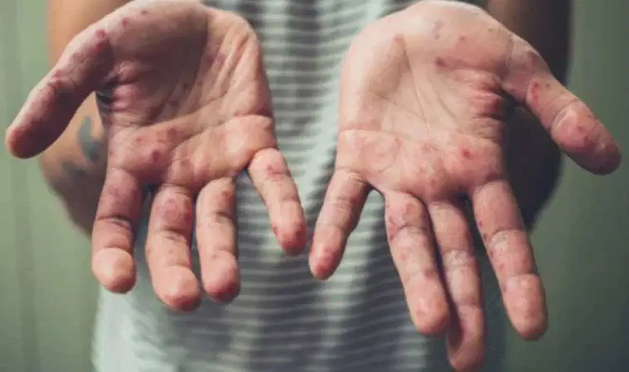 Bu salgın son 30 yılın zirvesinde! Can kayıpları var, önlem alınmazsa binlerce kişi ölebilir