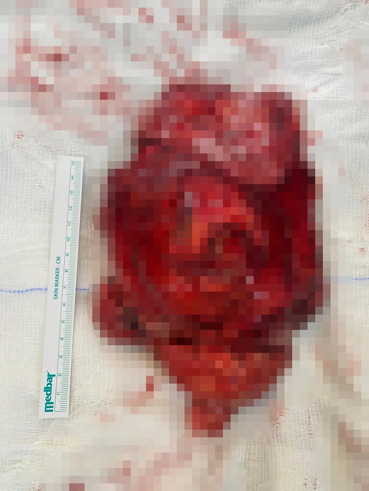 Göğsünden çıkan şoke etti! Tıpta 2,5 milyonda bir görülüyor, sıra dışı ameliyatla alındı