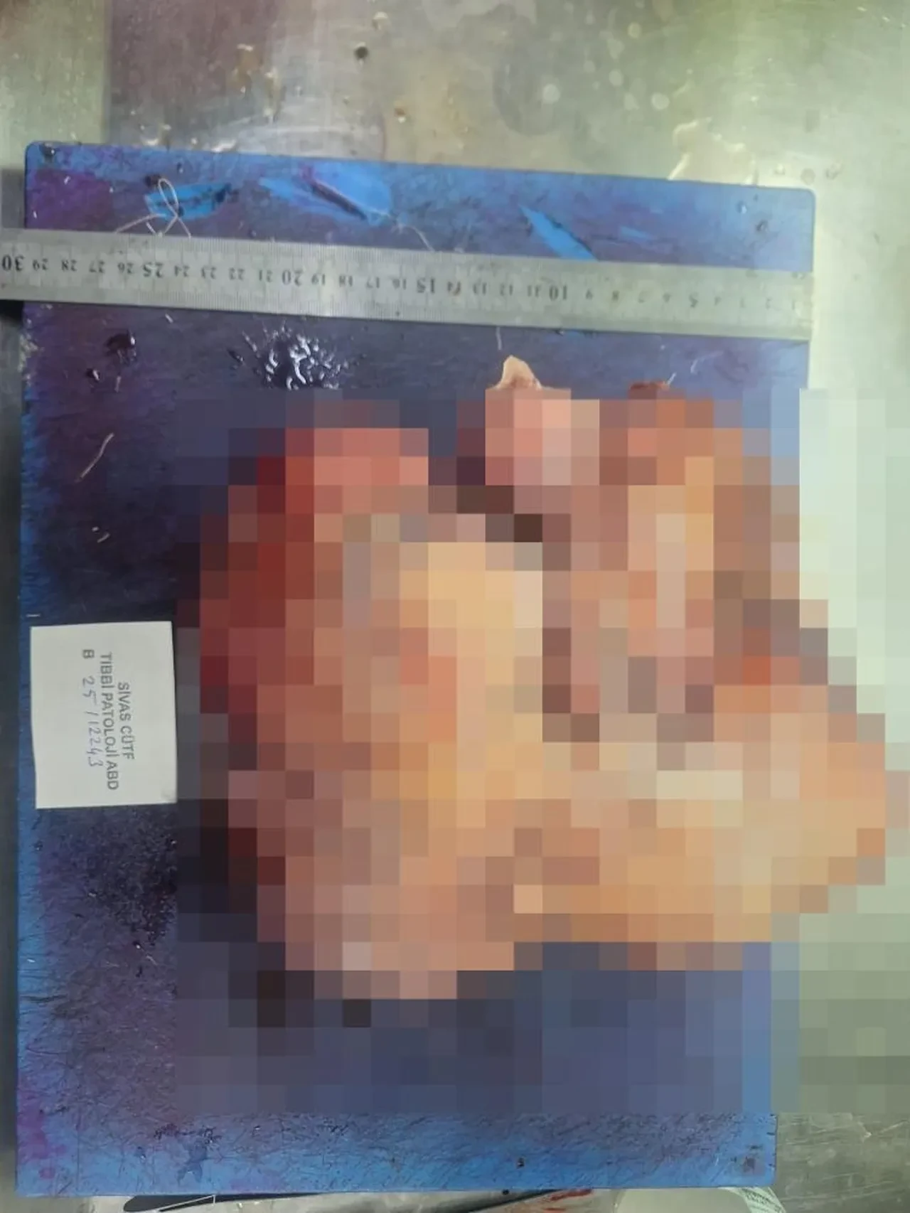 Nefes darlığı şikayetiyle gitti, göğsünden çıkan şey doktorları da şaşırttı 