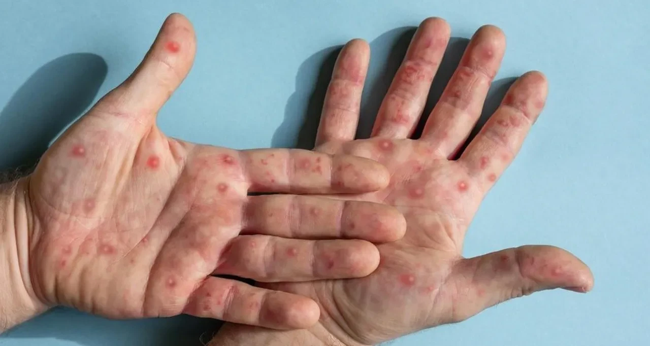 Yeni salgın kapıda! DSÖ uyardı: Ölümcül virüs 4 kıtaya yayıldı