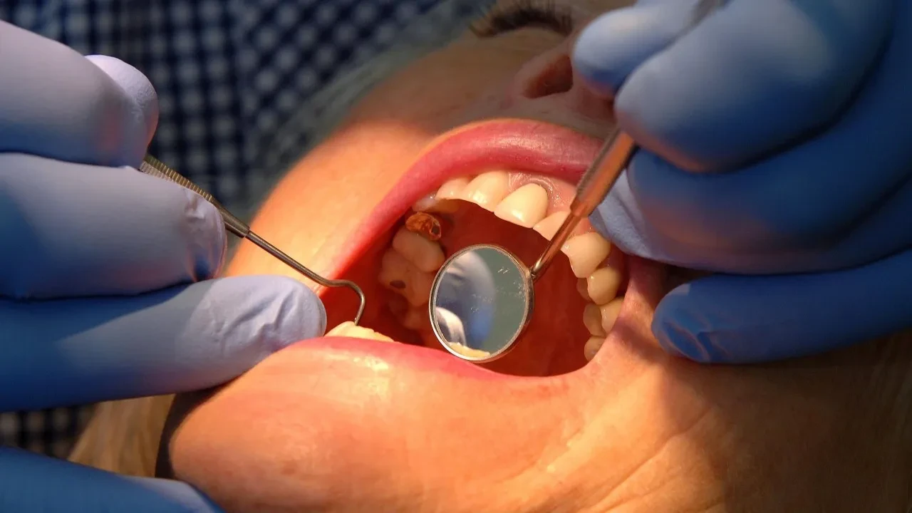 Diş çürüğü sorunu, yeni yöntem sonrası tarihe karışabilir! Bilim insanları 'imkansızı' başardı