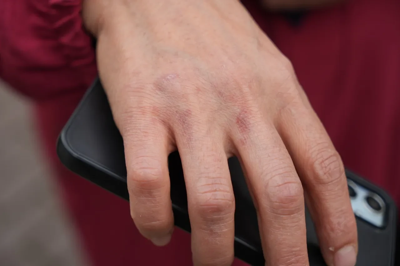 Yangın faciasından yaralı kurtulmuştu, dehşet anlarını anlattı: “Üstümü söndürsünler diye kendimi dışarı attım”