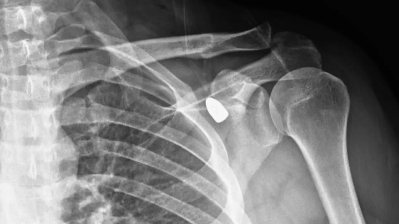 Yorgun mermi 6 yıl sonra çıkarıldı! Omza giren mermi koltuk altından çıktı