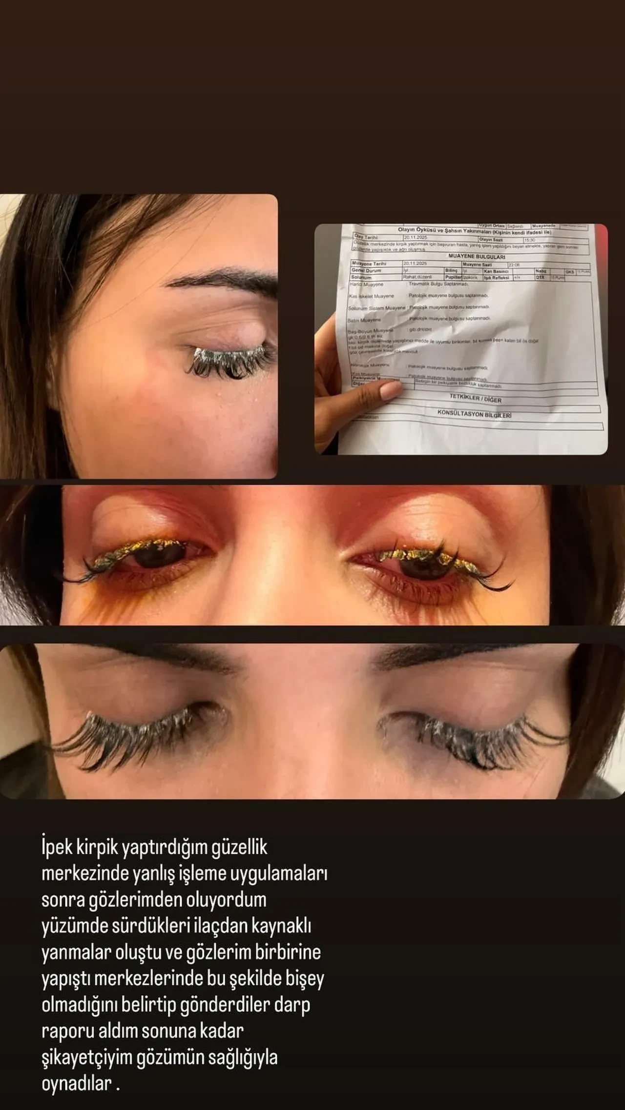 Kirpiği için gözünden oluyordu! Gözüne yapıştırıcı kaçtı, genç kadın kısmi körlük yaşadı