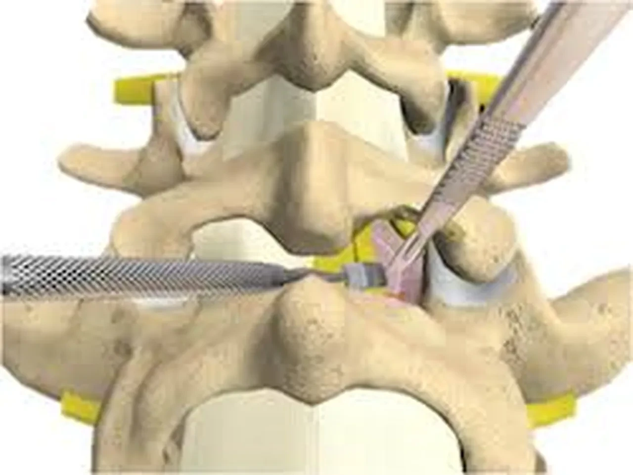 Bel fıtığı olanlar dikkat! "Masada kalırsın" dediler: Ameliyattan saatler sonra yürüdü