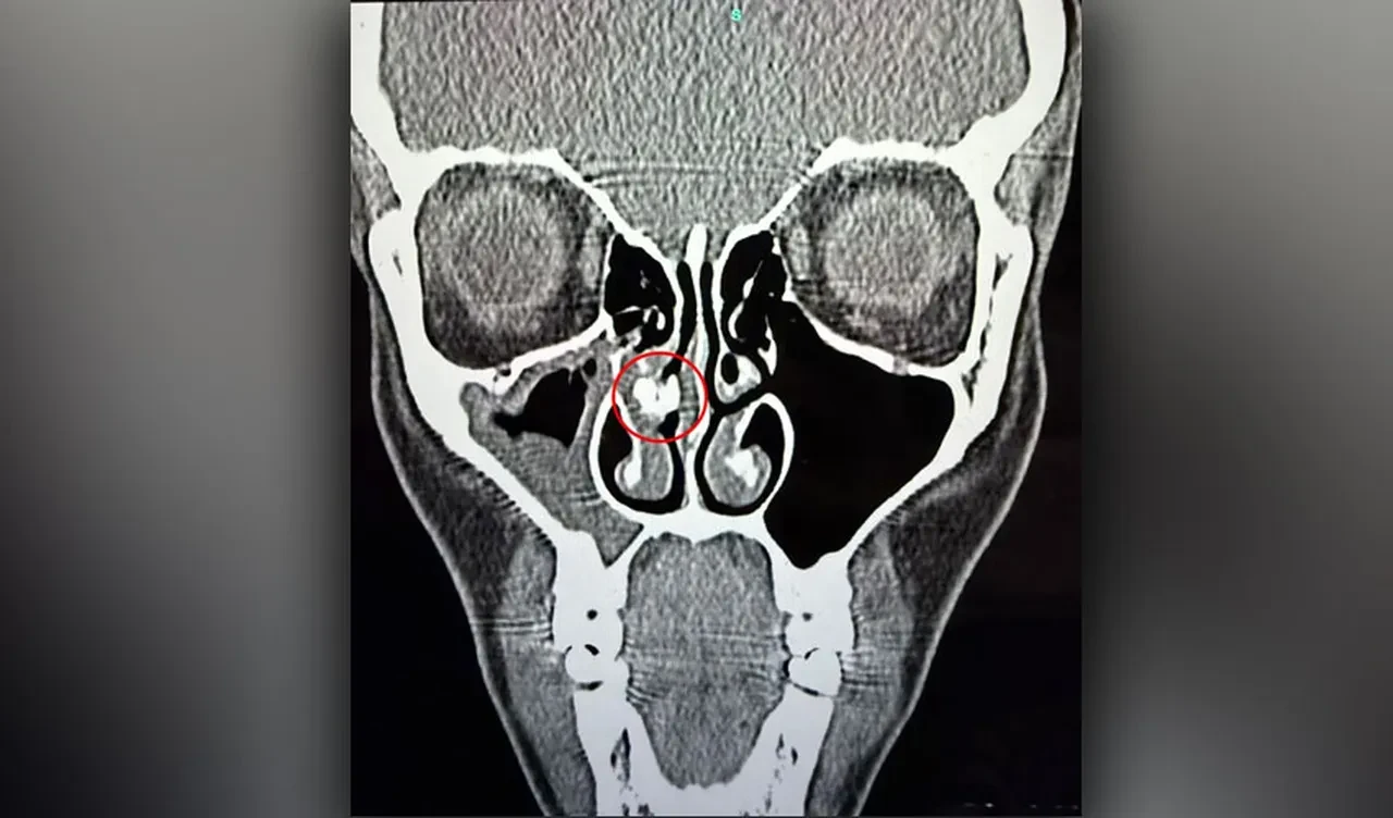 Otuz beş sene solunum sıkıntısı çekti: Burnundan çıkan herkesi şoke etti