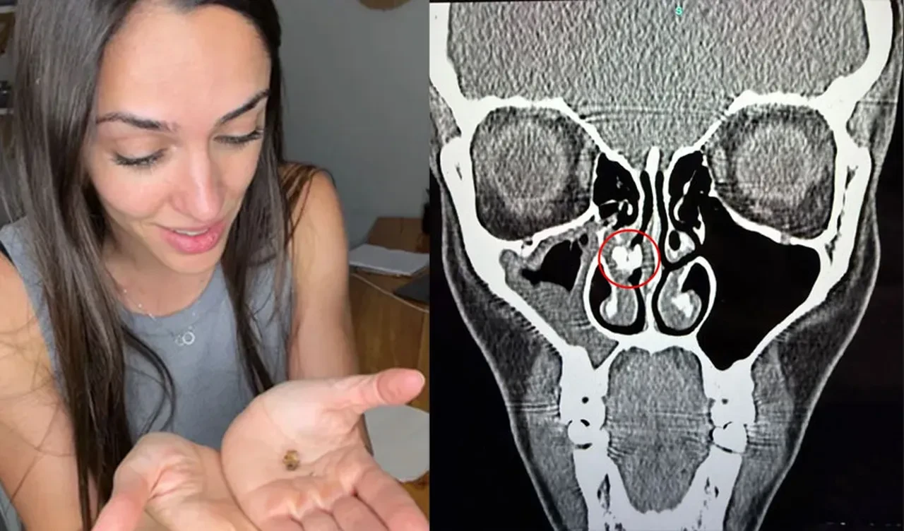 Otuz beş sene solunum sıkıntısı çekti: Burnundan çıkan herkesi şoke etti