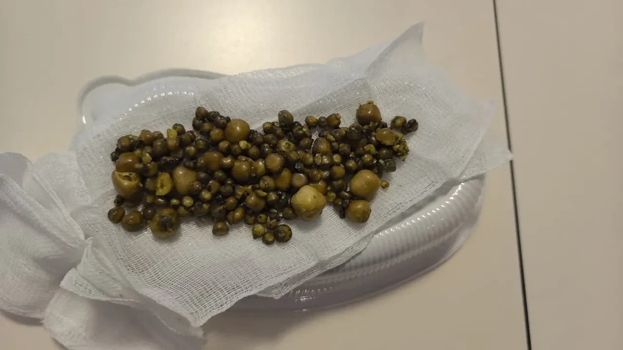 Doktorlar şaşkına döndü, tek tek karnından çıkardılar! Tam 213 tane çıktı