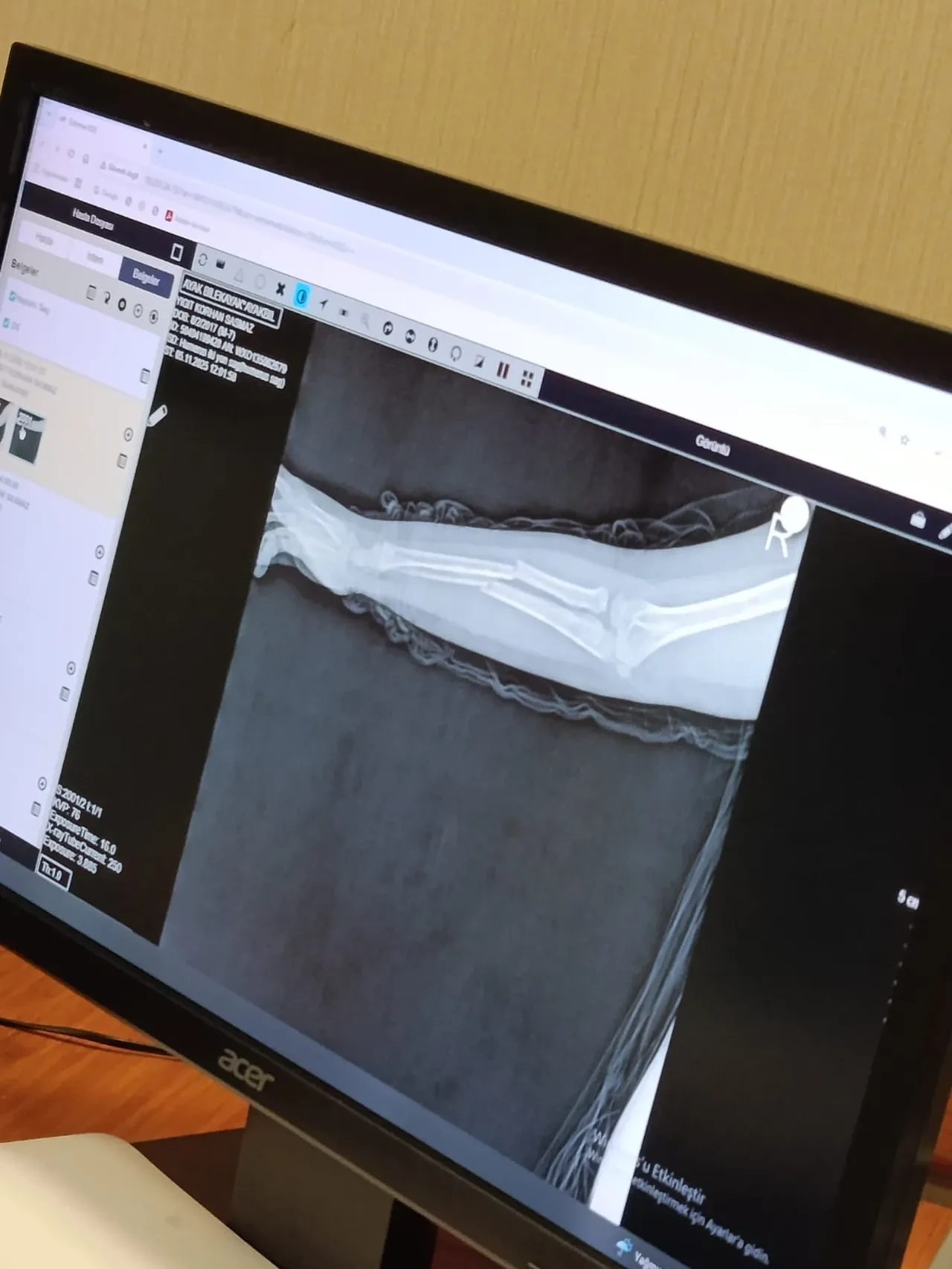 İlkokulda dehşet: 9 yaşındaki çocuk arkadaşının kolunu 2 yerden kırdı, sözleri şoke etti! 'İntikamımı aldım'