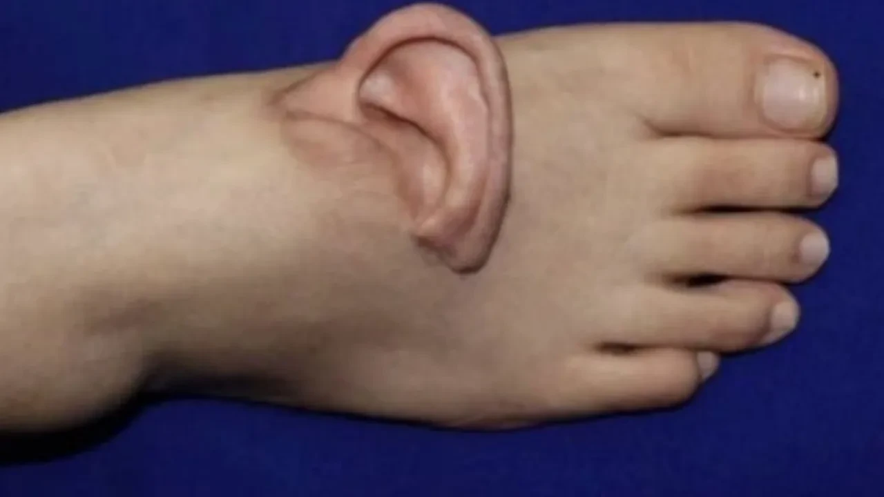 Kulaklı ayak! İş kazasının ardından tuhaf ve başarılı çözüm