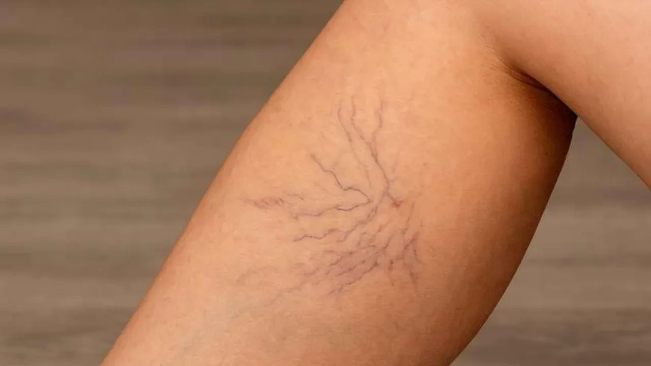 'Bacaklarım yorgunluktan ağrıyordur' diyenler dikkat! Damar hastalığınız olabilir