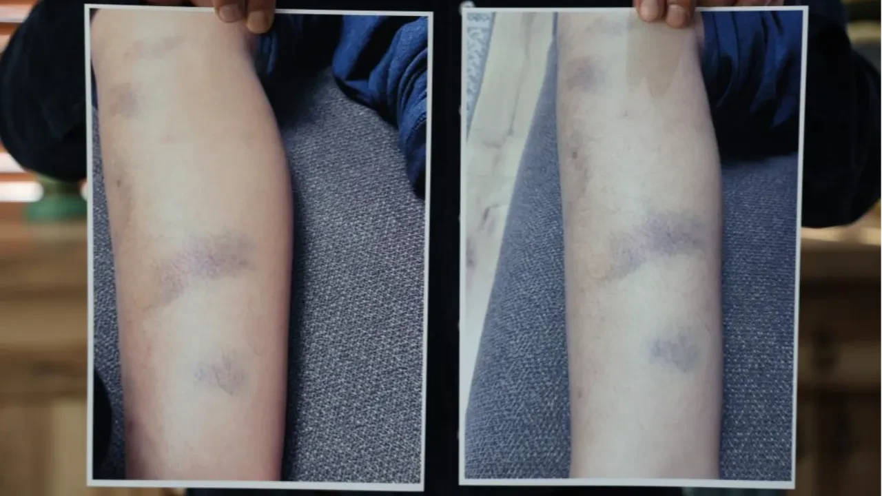 Aile okulu, okul aileyi suçladı! Özel okulda darp iddiası!