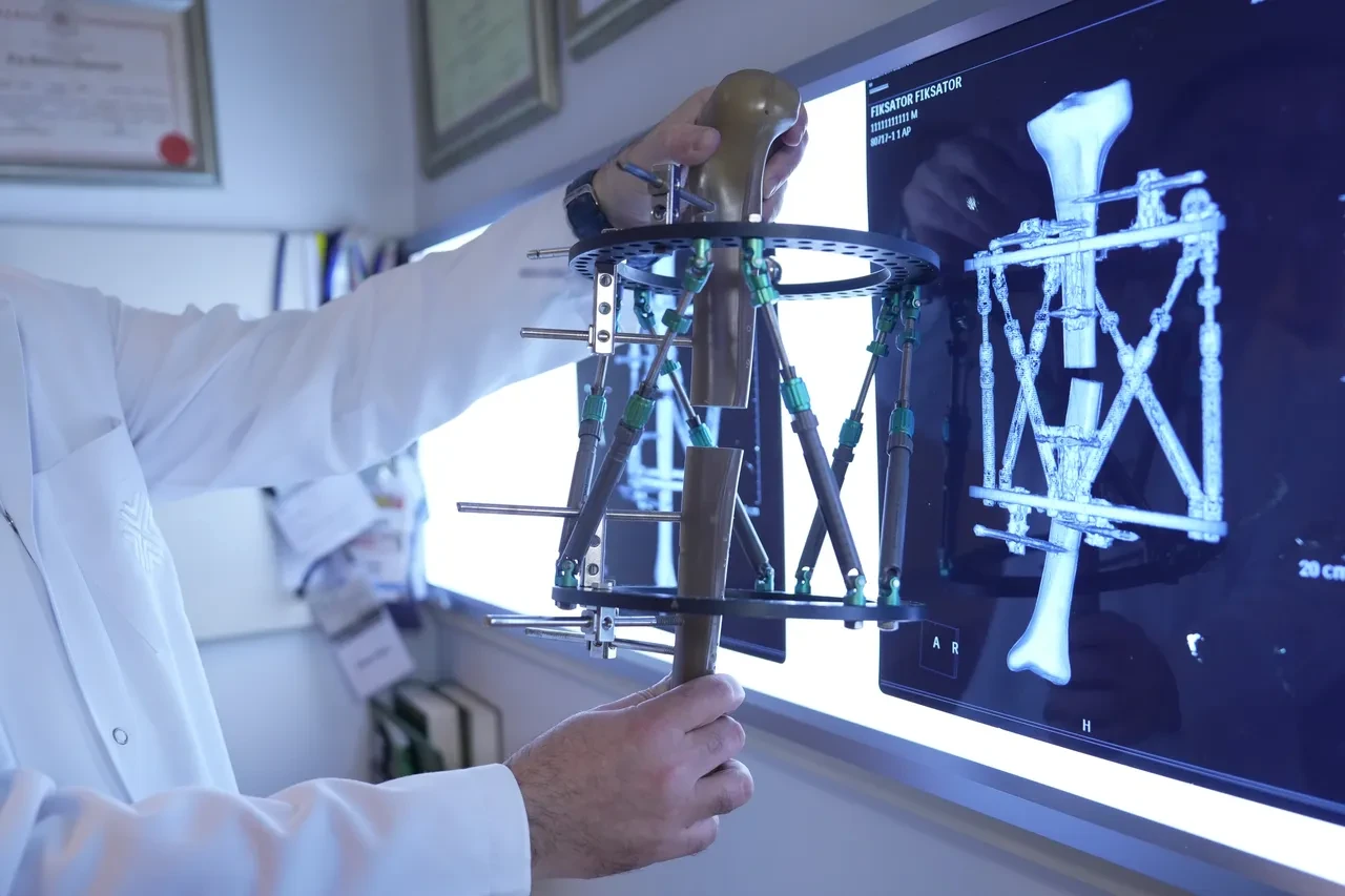 Boy kısalığına karşı modern çözüm: Kemik uzatma yöntemleri!