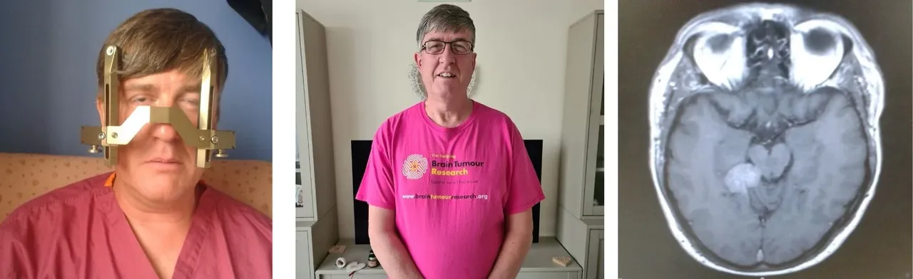 Masum bir kulak çınlaması sandı, altından büyük bir hastalık çıktı: Gerçek, MR taramasında görüldü