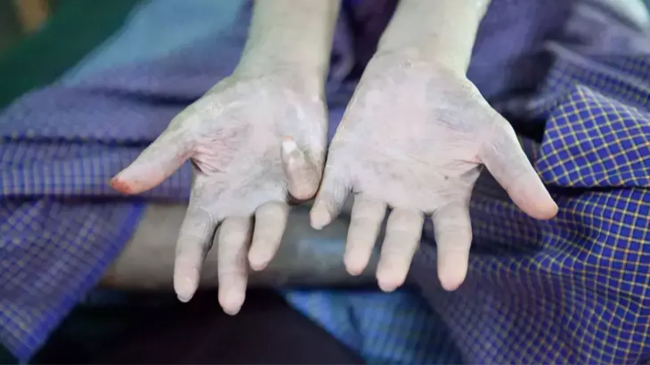 Onlarca sene sonra yeniden hortlayan cüzzam hastalığı AB'yi endişeye sürükledi