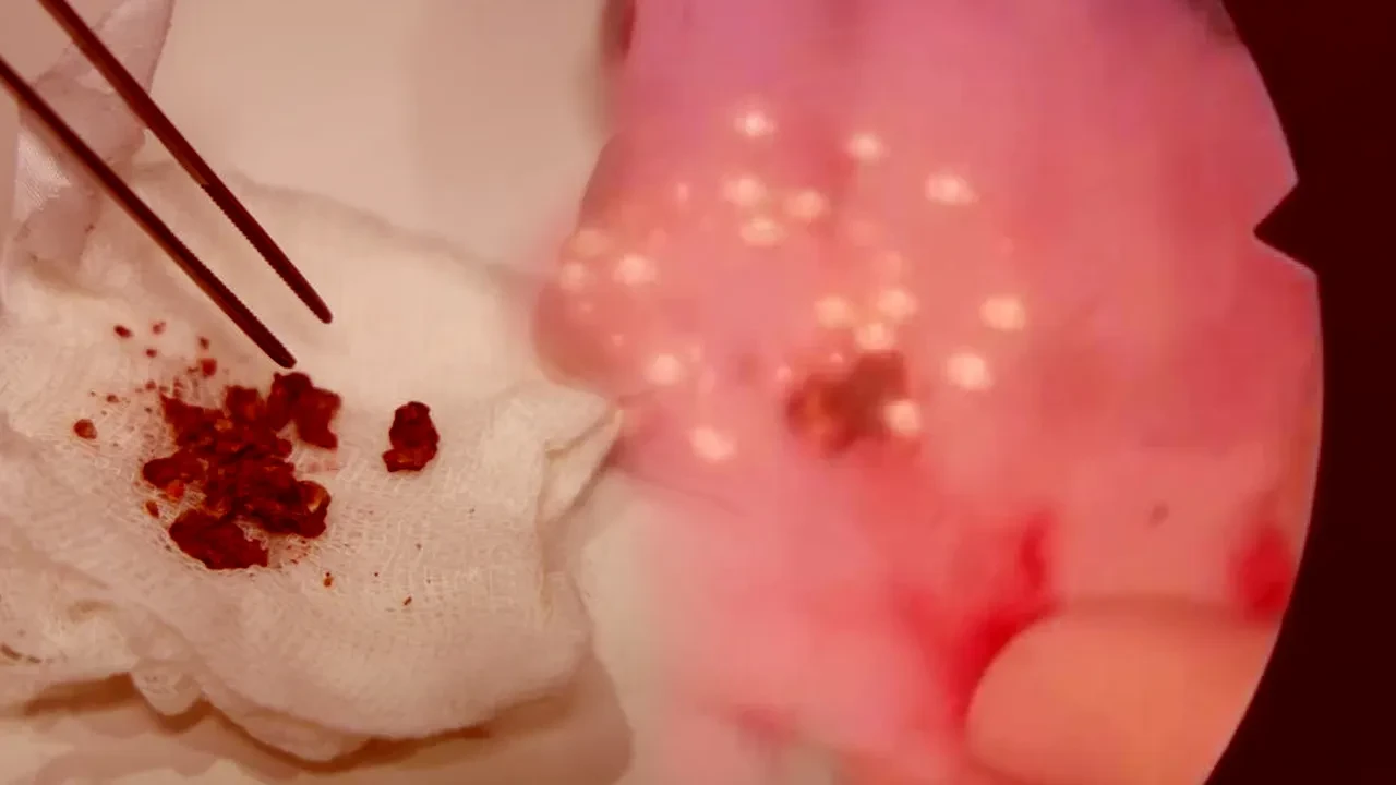 Estetik ameliyatta şoke eden olay! Burnundan çıkanlar şaşkına çevirdi 