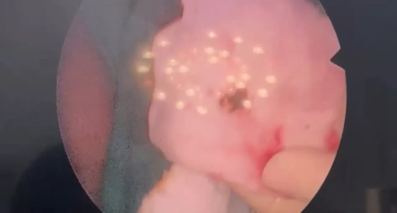 Estetik ameliyatta şoke eden olay! Burnundan çıkanlar şaşkına çevirdi 