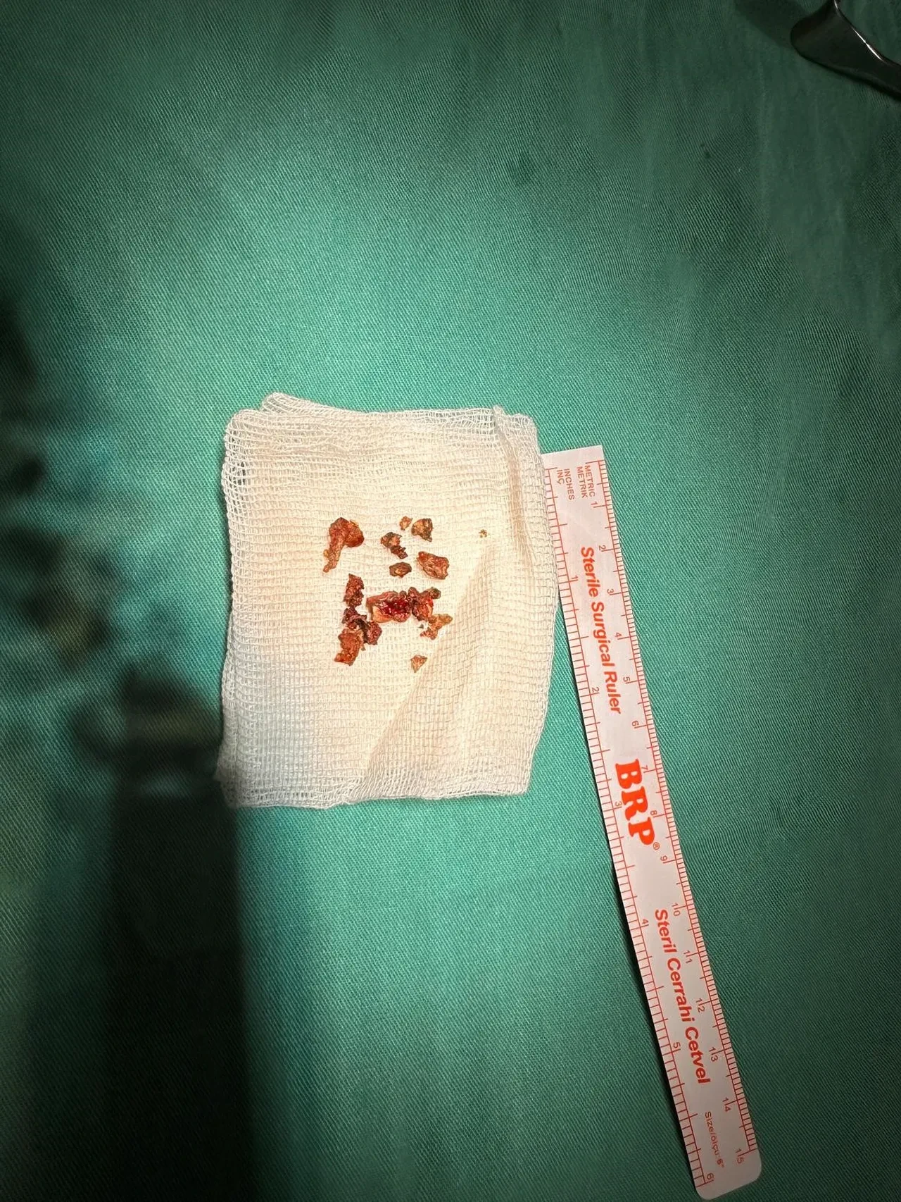 Estetik ameliyatta şoke eden olay! Burnundan çıkanlar şaşkına çevirdi 