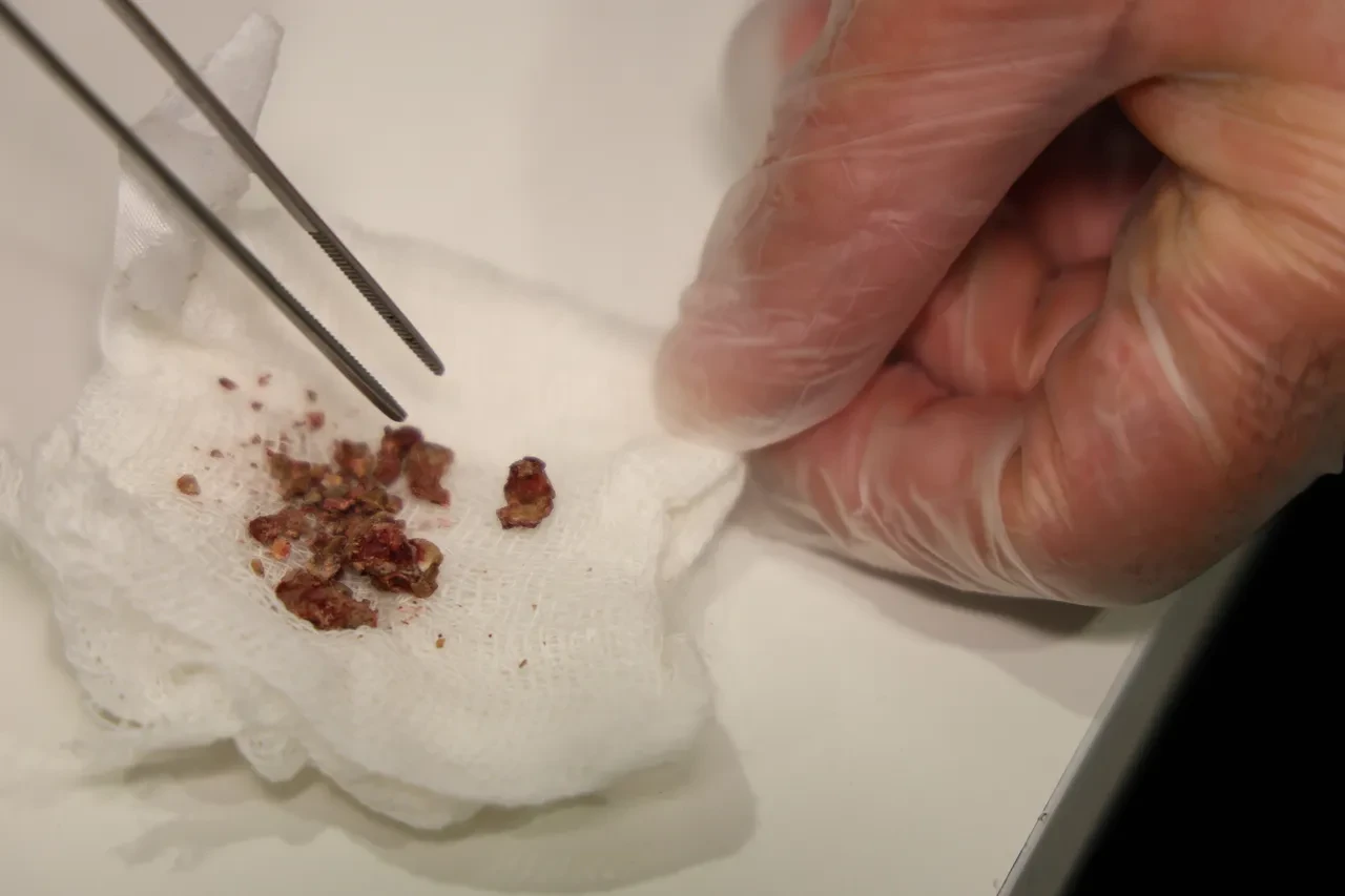 Estetik ameliyatta şoke eden olay! Burnundan çıkanlar şaşkına çevirdi 