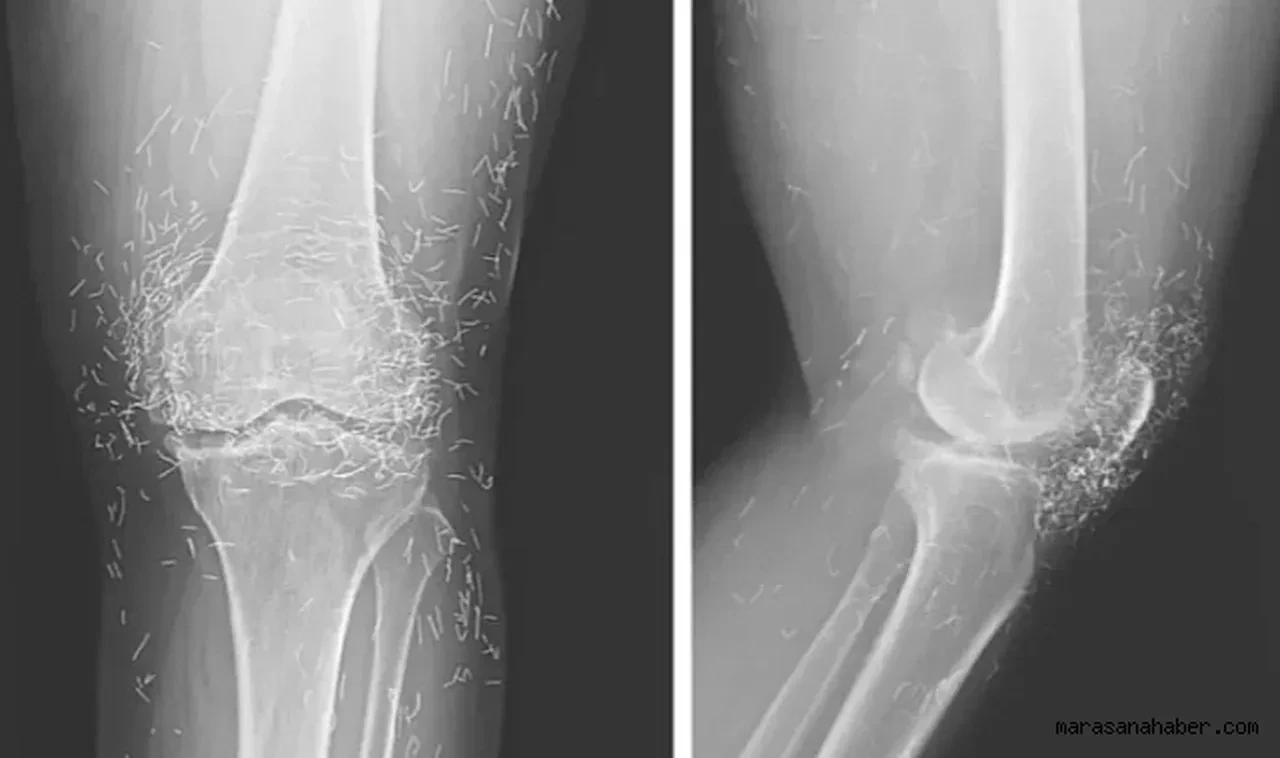 Dizde eklem hastalığı