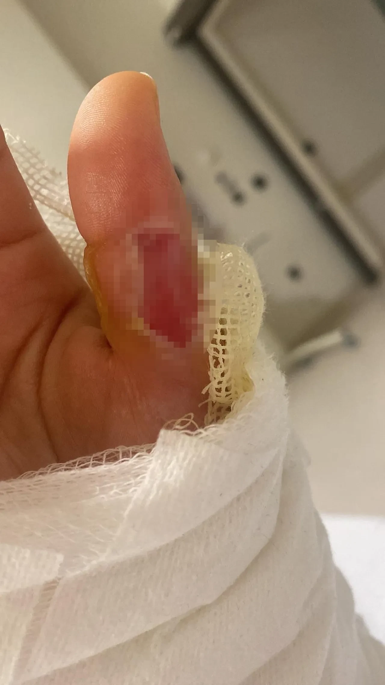 Ağrısını hafifletmek için sıcak su torbasına sarılanlar dikkat! Vücudunuz yanabilir: "Bu acının tarifi yok!"