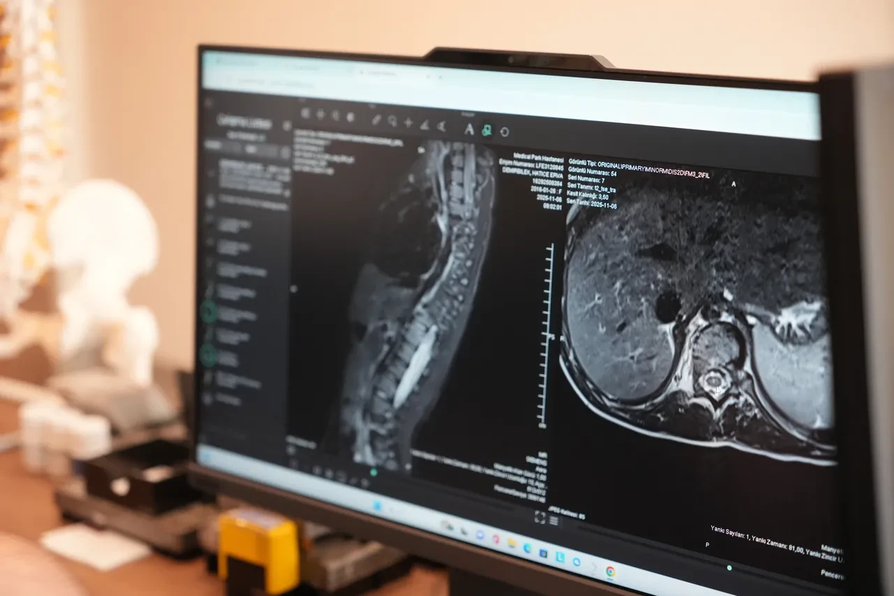 Sinsi hastalığı ilk fark eden anneler oluyor! Uzman isimden skolyoz hakkında çarpıcı bilgiler