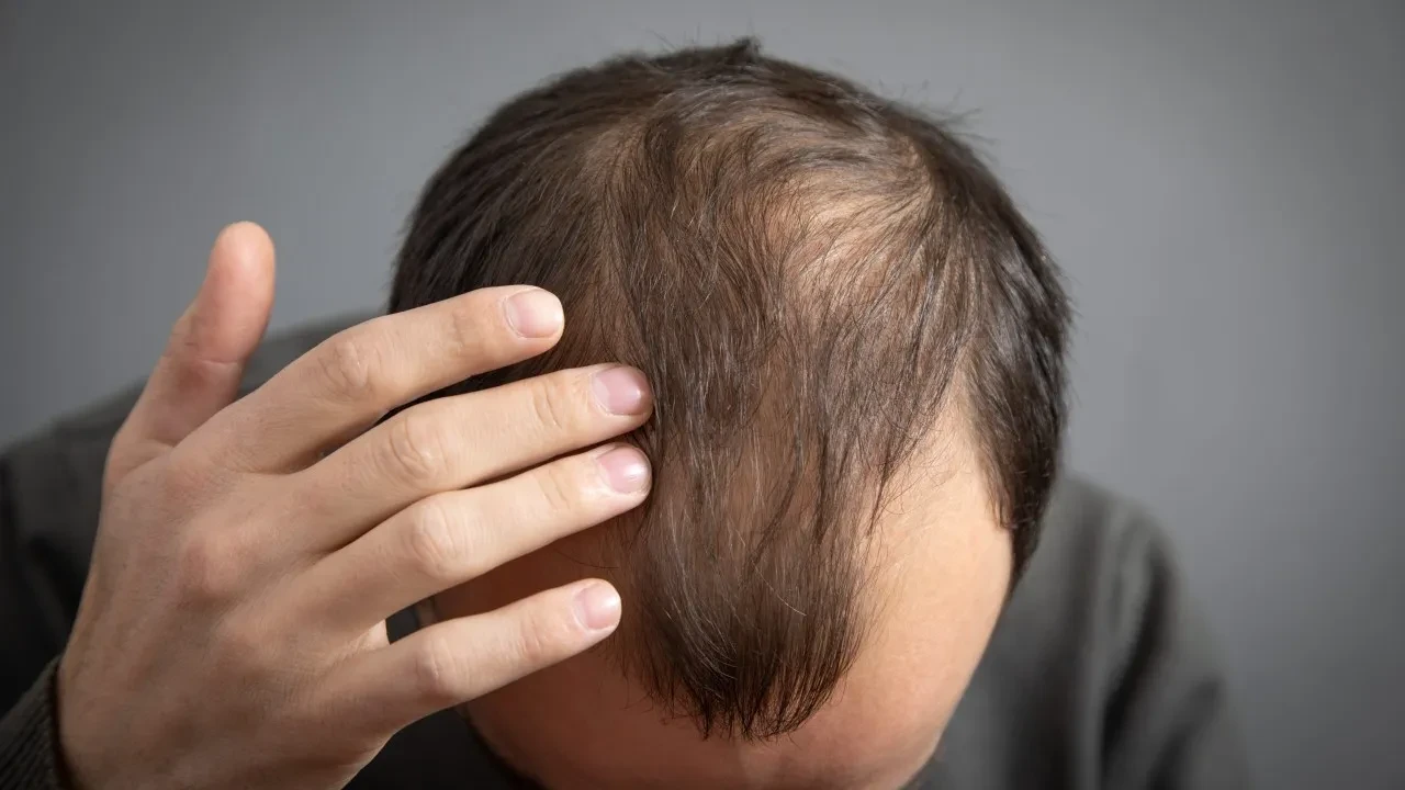 Saç çıkarmayı yüzde 539 artıran ilaç geliştirildi: Milyonlarca erkeği ilgilendiren müjde