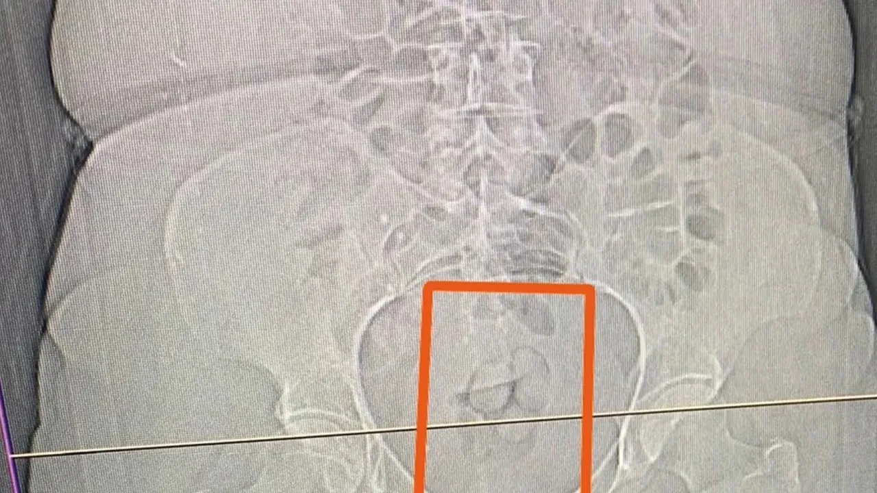 Ekipler bile şaşkına döndü! Midesinden 21,39 gram uyuşturucu çıktı