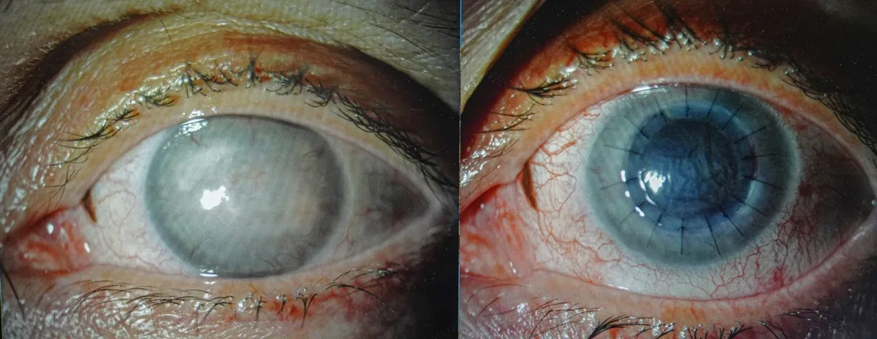 Medipol’de kornea nakli geçiren Libyalı kadın Van kedisi gibi güzel gözlere sahip oldu