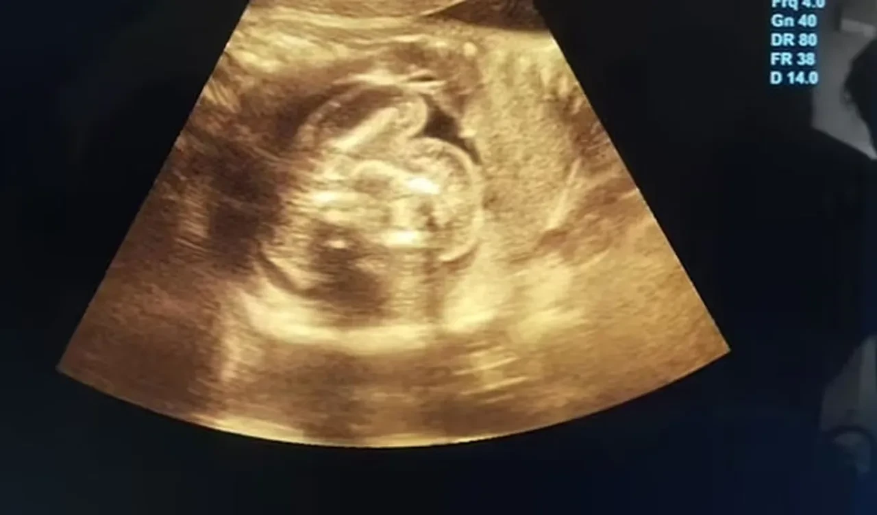Doğmamış bebeğin midesinde tespit edildi! Doktorlar bile şoke oldu