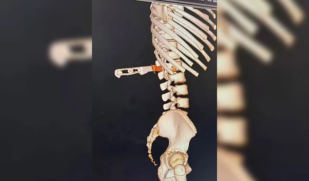 Ayağı kaydı, bulaşık makinesinin içine düştü! Felç olmaktan 'milimetrik' kurtuldu