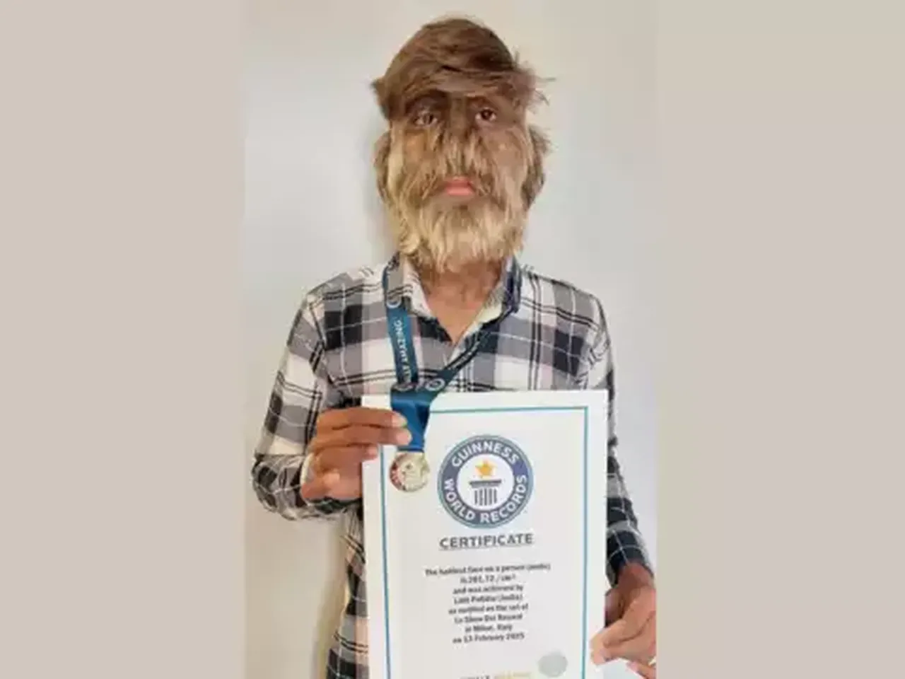 Yüzünün yüzde 95'i kıllarla kaplı olunca Guinness Dünya Rekorları'na girdi!