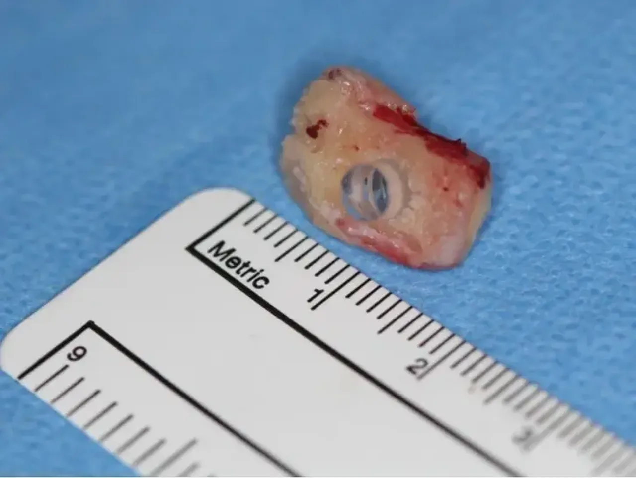 Dişine mercek yerleştirildi görme yetisini geri kazanacak!