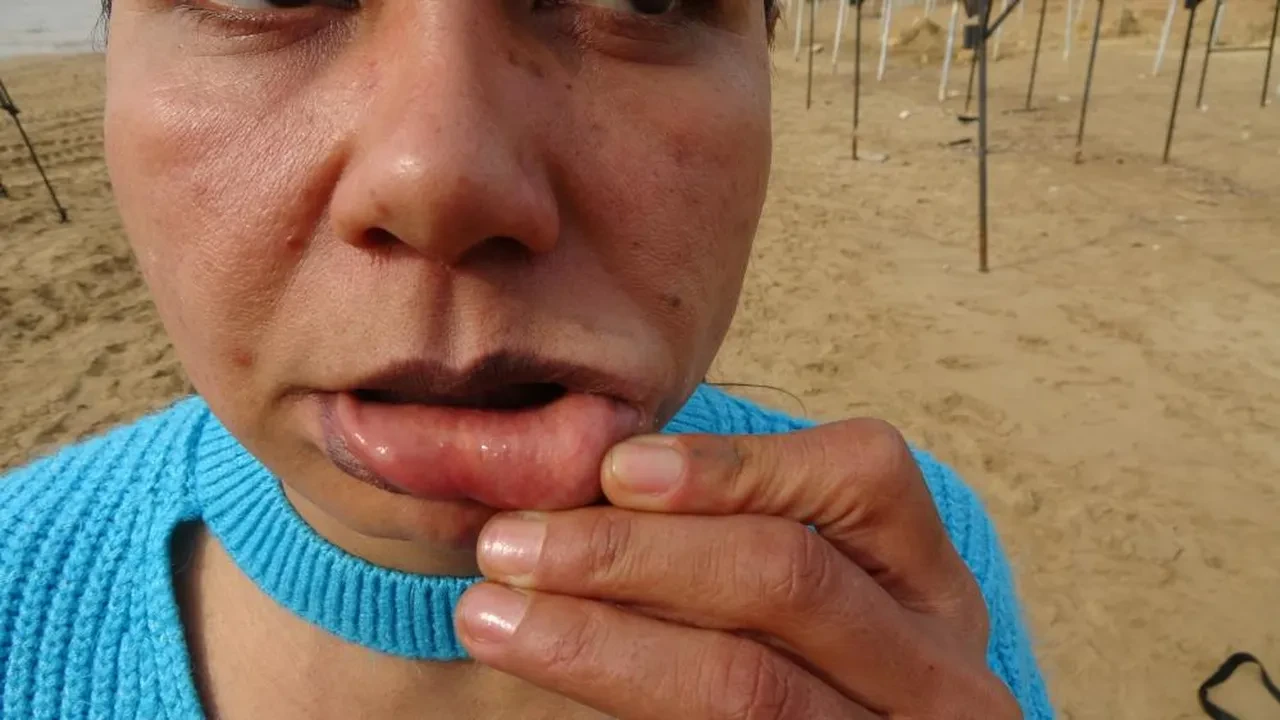 Estetiğe 200 bin TL harcadı, hayatı kabusa döndü